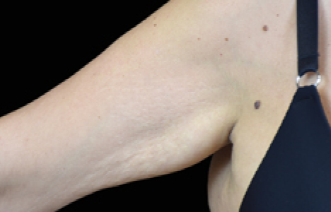 womans arm