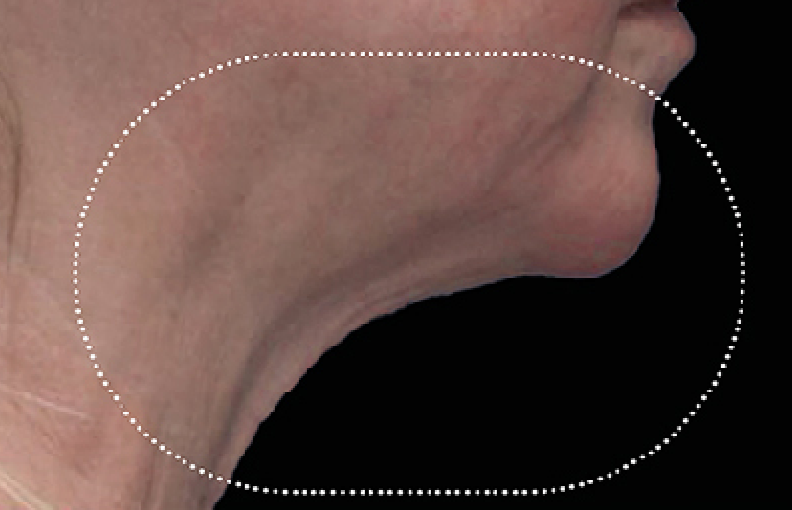 neck skin