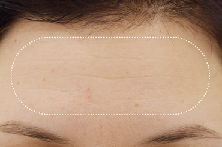 woman forehead