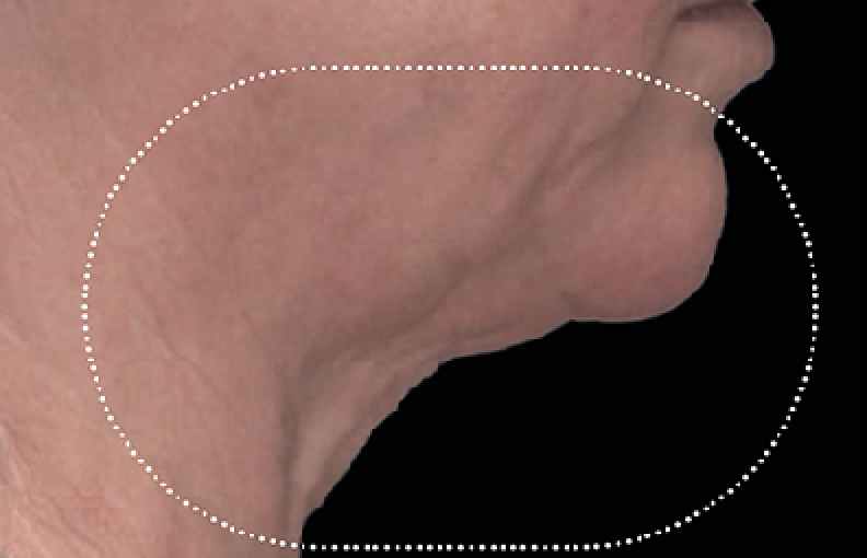 neck skin